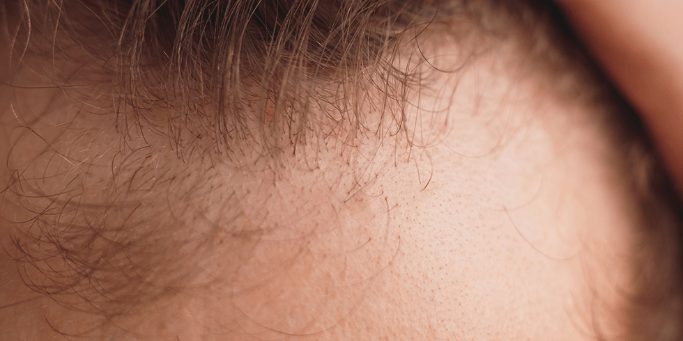 Calvície Masculina | Como Tratar a Alopecia Androgenética