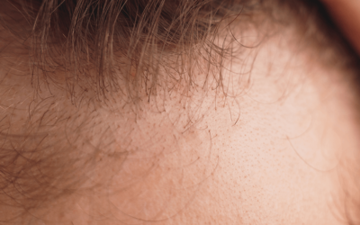 Calvície Masculina | Como Tratar a Alopecia Androgenética